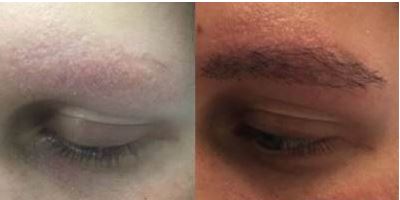 کاشت ابرو مردانه: ابروهایی پرپشت و طبیعی برای آقایان