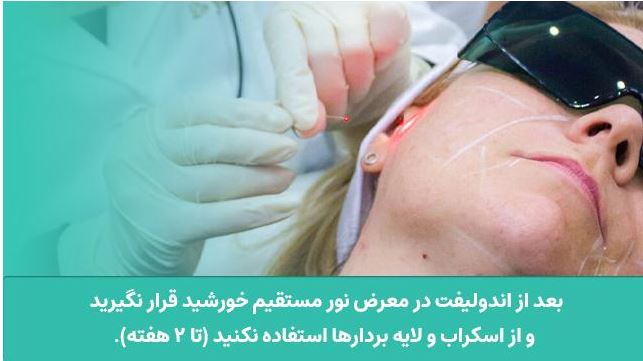 اندولیفت دردناک است؟ راهنمای کامل و مراقبتهای بعد از آن
