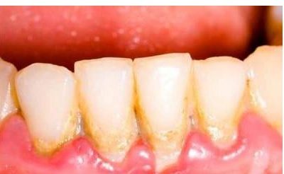 دندان‌هایی درخشان و بدون جرم با روش‌های خانگی